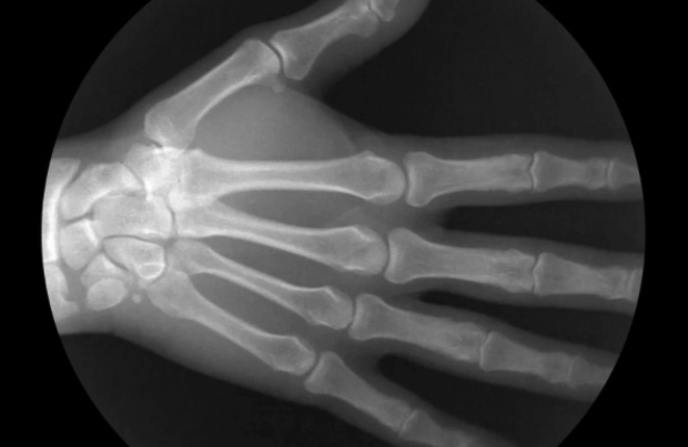X-ray